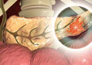 Cancro al pancreas: una combinazione di farmaci per "far morire di fame" le cellule tumorali