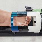 Ferite diabetiche, innovativo gel magnetico accelera la guarigione