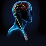 Ictus: i benefici della microstimolazione elettrica