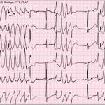 Torsione di punta: una forma potenzialmente letale di aritmia cardiacaTorsione di puntaTorsione di punta: una forma potenzialmente letale di aritmia cardiaca