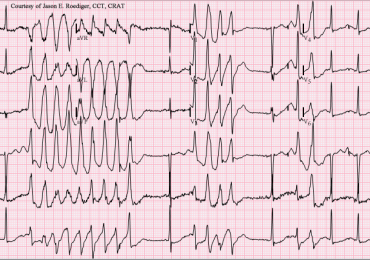 Torsione di punta: una forma potenzialmente letale di aritmia cardiacaTorsione di puntaTorsione di punta: una forma potenzialmente letale di aritmia cardiaca