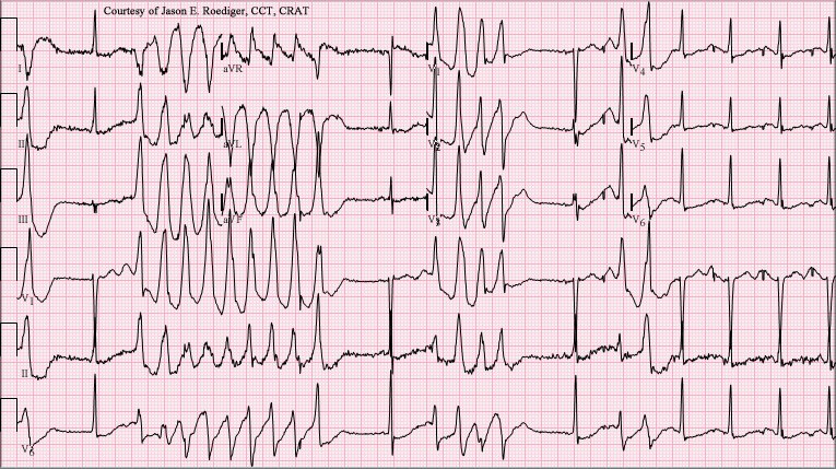 Torsione di punta: una forma potenzialmente letale di aritmia cardiacaTorsione di puntaTorsione di punta: una forma potenzialmente letale di aritmia cardiaca