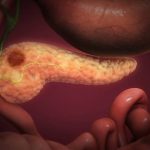 Tumore al pancreas, sviluppato nuovo anticorpo radioattivo per diagnosi e cura