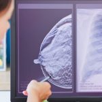 Tumore al seno: l'importanza dello screening per la diagnosi precoce