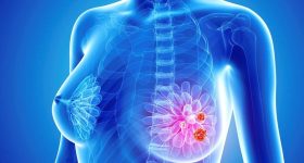 Tumore al seno, svolta nella cura: si può evitare la biopsia del linfonodo sentinella