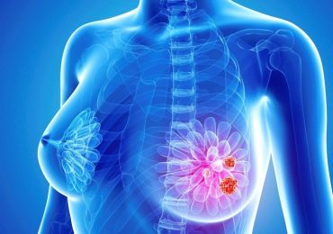 Tumore al seno, svolta nella cura: si può evitare la biopsia del linfonodo sentinella