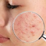 Acne: combinazione di tre farmaci per una nuova opzione di trattamento