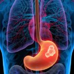 Cancro gastrico, individuato nuovo marcatore