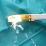 Iperplasia prostatica benigna: la terapia con vapore acqueo