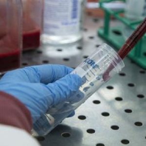 Sclerosi multipla, esame del sangue rivela peggioramento uno o due anni prima