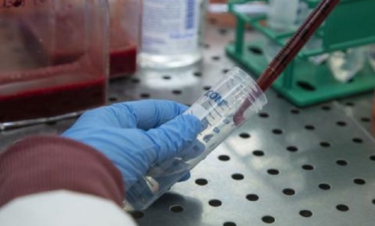 Sclerosi multipla, esame del sangue rivela peggioramento uno o due anni prima