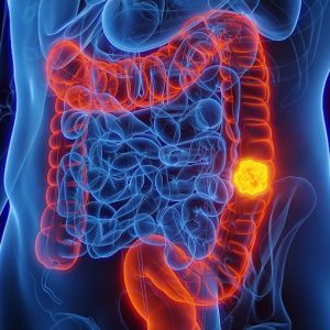 Tumore del colon retto: "soft robot" e "robot capsula" per uno screening più tolerabile