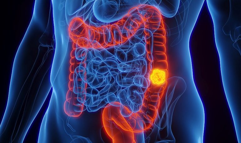 Tumore del colon retto: "soft robot" e "robot capsula" per uno screening più tolerabile