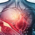 Aterosclerosi, un "atlante" fa luce sulle cause di infarti e ictus