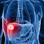 Carcinoma epatocellulare: possibile riduzione con terapia genica