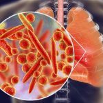 Polmoniti batteriche, Iss risponde a domande più frequenti su Mycoplasma pneumoniae
