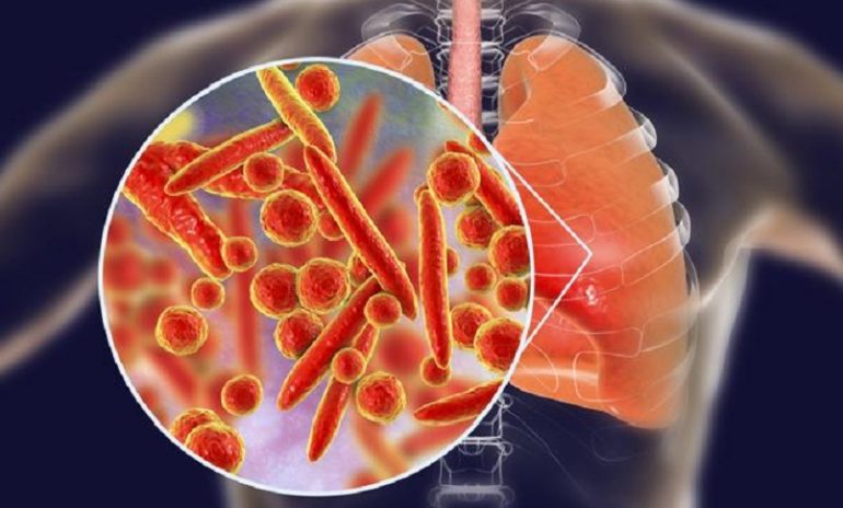 Polmoniti batteriche, Iss risponde a domande più frequenti su Mycoplasma pneumoniae