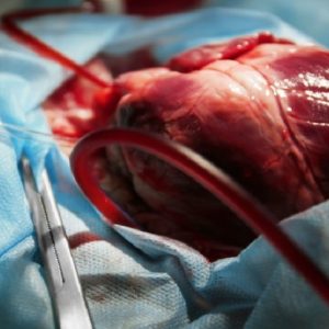 Un cuore per tre: eseguito negli Usa un innesto d'organo già trapiantato in precedenza