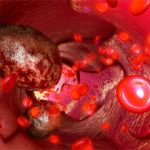 Neoplasie del sangue: aumentano le guarigioni, ma anche la cronicità. Regioni ancora indietro con le reti oncoematologiche