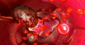 Neoplasie del sangue: aumentano le guarigioni, ma anche la cronicità. Regioni ancora indietro con le reti oncoematologiche