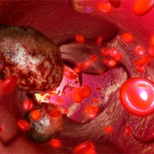 Neoplasie del sangue: aumentano le guarigioni, ma anche la cronicità. Regioni ancora indietro con le reti oncoematologiche