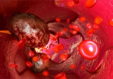 Neoplasie del sangue: aumentano le guarigioni, ma anche la cronicità. Regioni ancora indietro con le reti oncoematologiche