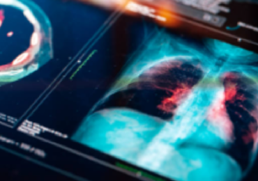 Tumore al polmone: possibile svolta dalla Tac a basso dosaggio