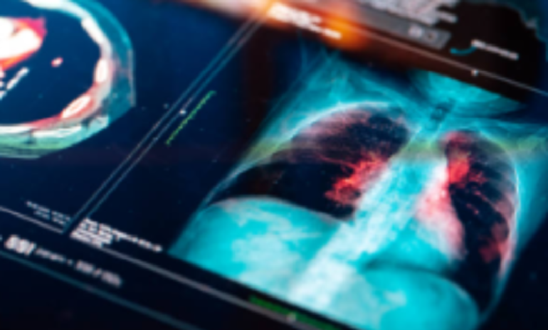 Tumore al polmone: possibile svolta dalla Tac a basso dosaggio