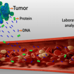 Tumori, nuovo test del sangue li rileva con precisione in stadio iniziale