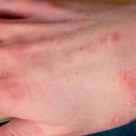 Scabbia: sintomi, diagnosi, terapia e prognosi. Tutto ciò che devi sapere 1