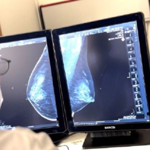 Tumore al seno, intelligenza artificiale predice rischio di effetti collaterali dopo chirurgia e radioterapia