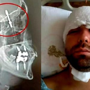 Dentista spinge troppo una vite e la conficca nel cranio del paziente: fa notizia un grave errore medico in Turchia