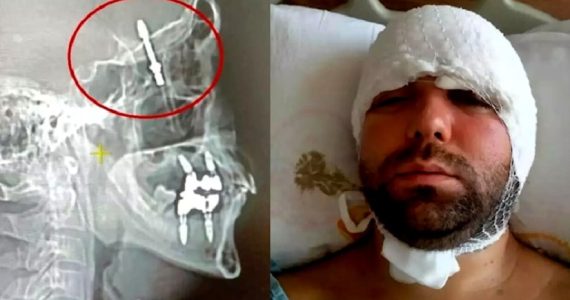 Dentista spinge troppo una vite e la conficca nel cranio del paziente: fa notizia un grave errore medico in Turchia
