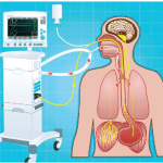 La metodologia di ventilazione NAVA: indicazioni terapeutiche e monitoraggio dell’attività elettrica del diaframma (Edi) 5