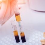 L'uso del plasma ricco di piastrine (PRP) nel wound care