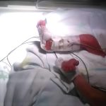 Studio caso-controllo sull’uso della colla istoacrilica per il fissaggio dei cateteri epicutaneo-cavali nei neonati