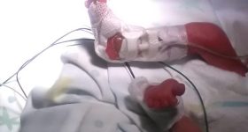 Studio caso-controllo sull’uso della colla istoacrilica per il fissaggio dei cateteri epicutaneo-cavali nei neonati