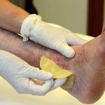 Ferite diabetiche: allo studio nuova terapia rigenerativa