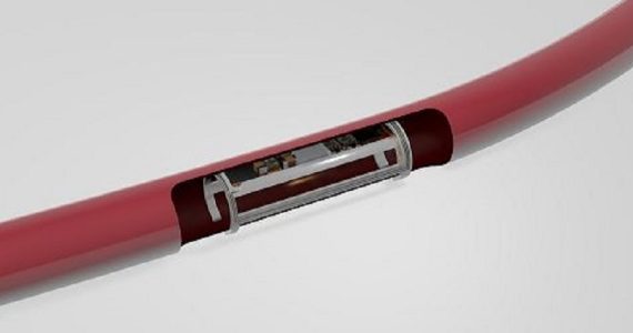 Un dispositivo multisensore impiantabile nei vasi sanguigni per monitorare lo stato di salute: al via il progetto IV-Lab
