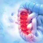 Tumore all'intestino: nuove speranze dal farmaco immunoterapico Pembrolizumab. Potrebbe sostituire la chirurgia