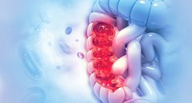 Tumore all'intestino: nuove speranze dal farmaco immunoterapico Pembrolizumab. Potrebbe sostituire la chirurgia