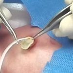 Gestione del catetere venoso ombelicale (CVO) nel setting neonatale: strategie di riduzione del rischio infettivo