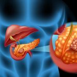 Lesioni precancerose nel pancreas, sviluppata tecnica 3D per identificarle