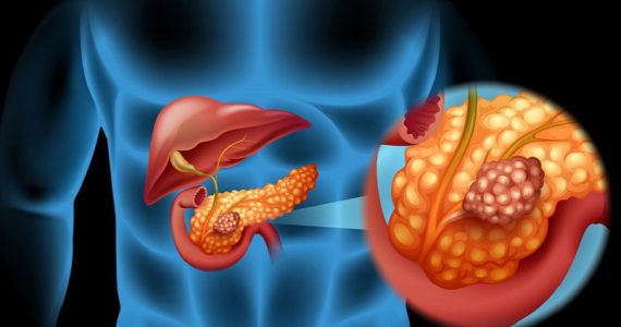 Lesioni precancerose nel pancreas, sviluppata tecnica 3D per identificarle