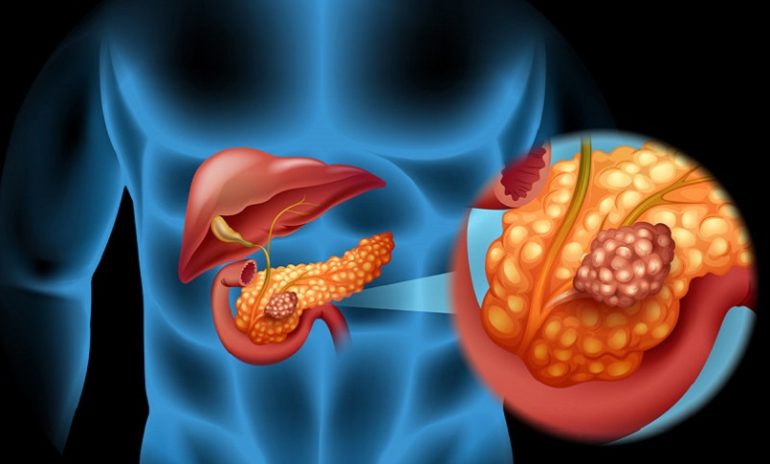 Lesioni precancerose nel pancreas, sviluppata tecnica 3D per identificarle