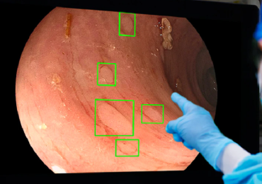 Intelligenza artificiale e colonscopie: aumentano le possibilità di individuare anomalie che portano al cancro intestinale