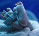 Ipoglicemia neonatale transitoria: diagnosi e trattamento