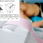 Pills Emiblocco Anteriore Sinistro (EAS): come riconoscerlo all’ ECG