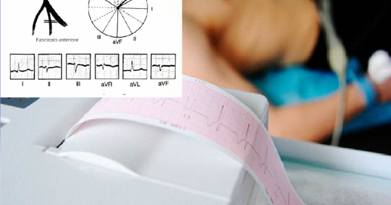 Pills Emiblocco Anteriore Sinistro (EAS): come riconoscerlo all’ ECG