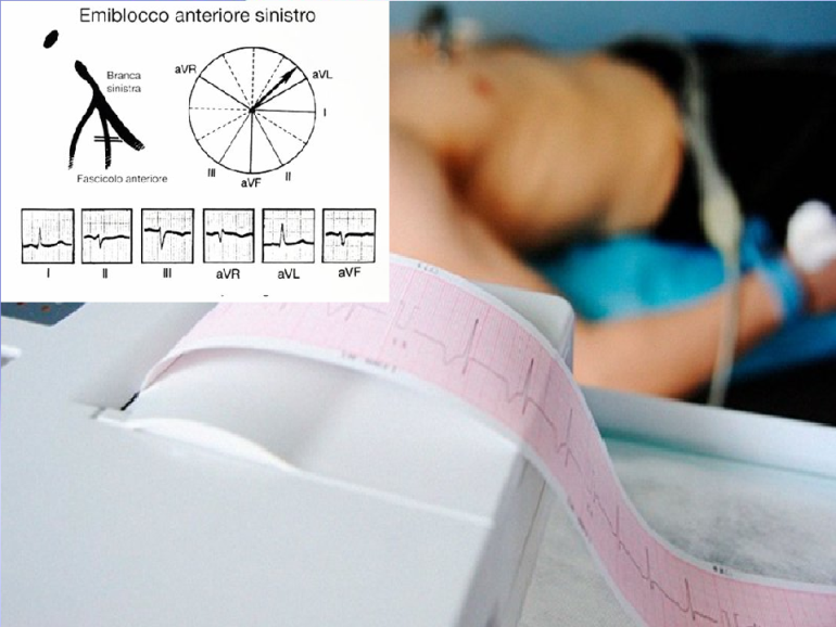 Pills Emiblocco Anteriore Sinistro (EAS): come riconoscerlo all’ ECG